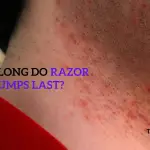How long do Razor Bumps last