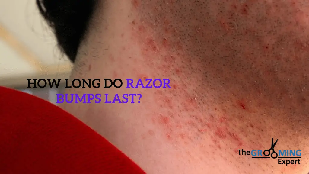 How long do Razor Bumps last